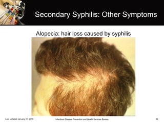 62
Secondary Syphilis: Other Symptoms
Infectious Disease Prevention and Health Services BureauLast updated January 31, 2018
Alopecia: hair loss caused by syphilis
 