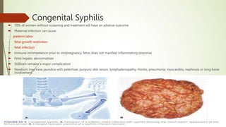 Congenital Syphilis
 70% of women without screening and treatment will have an adverse outcome
 Maternal infection can cause:
- preterm labor
- fetal growth restriction
- fetal infection
 Immune incompetence prior to midpregnancy, fetus does not manifest inflammatory response
 Fetal hepatic abnormalities
 Stillborn remains a major complication
 Newborn may have jaundice with petechiae, purpuric skin lesion, lymphadenopathy, rhinitis, pneumonia, myocarditis, nephrosis or long bone
involvement
 