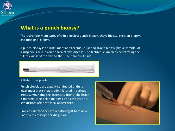 Stiefel biopsy punches and curettes