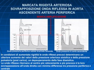 MARCATA RIGIDITÀ ARTERIOSA
SOVRAPPOSIZIONE ONDA RIFLESSA IN AORTA
ASCENDENTE ARTERIA PERIFERICA
Onda pressioria periferica radiale brachiale femorale Onda pressoria in aorta ascendente
In condizioni di aumentata rigidità le onde riflessi precoci determinano un
ulteriore aumento dei valori della pressione arteriosa sistolica e della pressione
pulsatoria (post carico), un depauperamento della fase diastolica.
Le onde riflesse ritornano al centro più velocemente e più precoce è la loro
sovrapposizione all’onda diretta con minima differenza tra pressione periferica e
centrale
MANCA AMPLIFICAZIONE
 