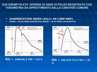 DUE ESEMPI IN ETA’ DIVERSE DI ONDE DI POLSO REGISTRATE CON
TONOMETRIA DA APPIATTIMENTO SALLA CAROTIDE COMUNE
 AUGMENTATION INDEX (AIx)= AP/(SBP-DBP)
 SEGNO + SE SU ONDA ANACROTICA SEGNO – SE SU ONDA CATACROTICA
AIx = -2/(94-64) X 100 = - 6,6 % AIx = +28 /(157-77) X 100 = + 35
%
 