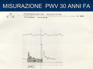 MISURAZIONE PWV 30 ANNI FAMISURAZIONE PWV 30 ANNI FA
 
