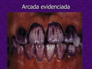 Arcada evidenciada 