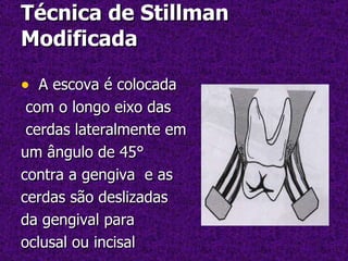 Técnica de Stillman Modificada  A escova é colocada com o longo eixo das cerdas lateralmente em um ângulo de 45° contra a gengiva  e as  cerdas são deslizadas da gengival para  oclusal ou incisal  