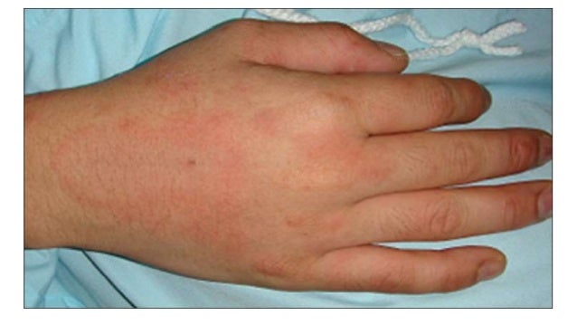 stills disease still s disease