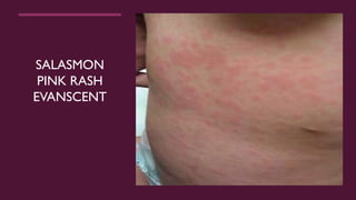 Still's disease & Macrophage activation syndrome Dr Rehab Rabea ...