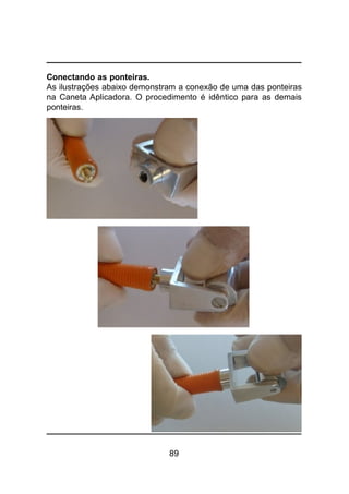 89
Conectando as ponteiras.
As ilustrações abaixo demonstram a conexão de uma das ponteiras
na Caneta Aplicadora. O procedimento é idêntico para as demais
ponteiras.
 