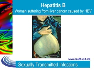 Sexually Transmitted Infections
www.healthunit.org
Hepatitis B
Woman suffering from liver cancer caused by HBV
Photo courtesy of
Patricia Walker, MD
 