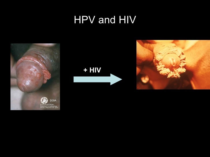 Resultado de imagem para HIV E HPV