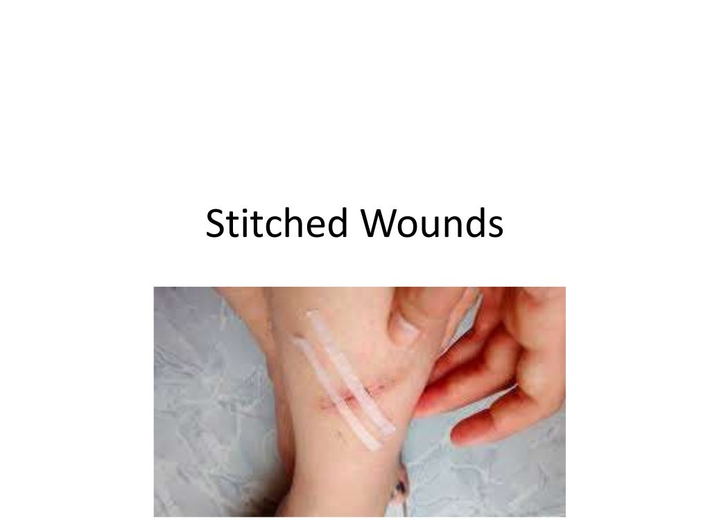 Stitched wounds