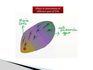 STN Deep brain stimulation in Parkinson's disease | PPTX