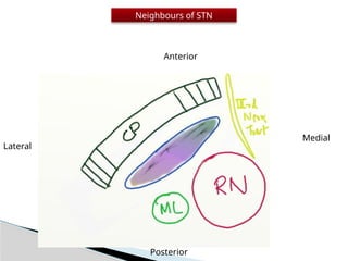 STN Deep brain stimulation in Parkinson's disease | PPTX