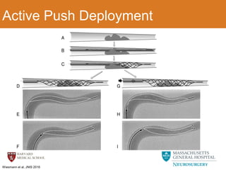 MECHANICAL THROMBECTOMY IN ACUTE ISCHEMIC STROKE | PDF