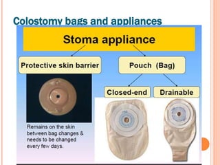 Stoma Device Stoma | PPTX