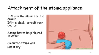 Attachment of the stoma appliance
JMJ 12
2. Check the stoma for the
colour
If it is black- consult your
doctor
Stoma has to be pink, red
in colour
Clean the stoma well
Let it dry
 