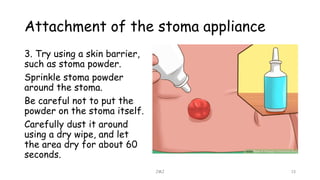 Attachment of the stoma appliance
JMJ 13
3. Try using a skin barrier,
such as stoma powder.
Sprinkle stoma powder
around the stoma.
Be careful not to put the
powder on the stoma itself.
Carefully dust it around
using a dry wipe, and let
the area dry for about 60
seconds.
 