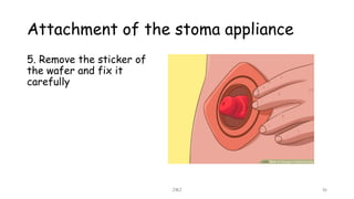 Attachment of the stoma appliance
JMJ 16
5. Remove the sticker of
the wafer and fix it
carefully
 