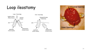 Loop ileostomy
JMJ 24
 