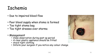 Ischemia
• Due to impaired blood flow
• Poor blood supply when stoma is formed
• Too tight stoma bag
• Too tight dresses over storma
• Management
• Close observation during post op period
• A clear plastic appliance should be fitted
• Avoid tight clothing
• Inform your surgeon if you notice any colour change
JMJ 30
 