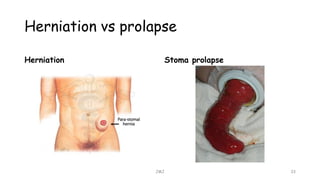 Herniation vs prolapse
Herniation Stoma prolapse
JMJ 33
 