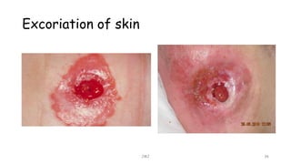 Excoriation of skin
JMJ 36
 