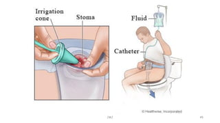 Requirement for stoma irrigation
JMJ 45
 