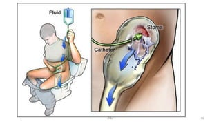 Requirement for stoma irrigation
JMJ 46
 