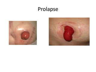 Prolapse
 