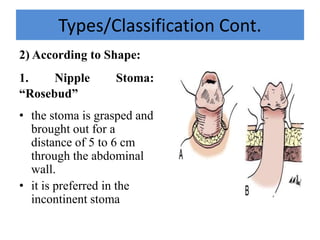 Types/Classification Cont.
2) According to Shape:
1. Nipple Stoma:
“Rosebud”
• the stoma is grasped and
brought out for a
distance of 5 to 6 cm
through the abdominal
wall.
• it is preferred in the
incontinent stoma
 