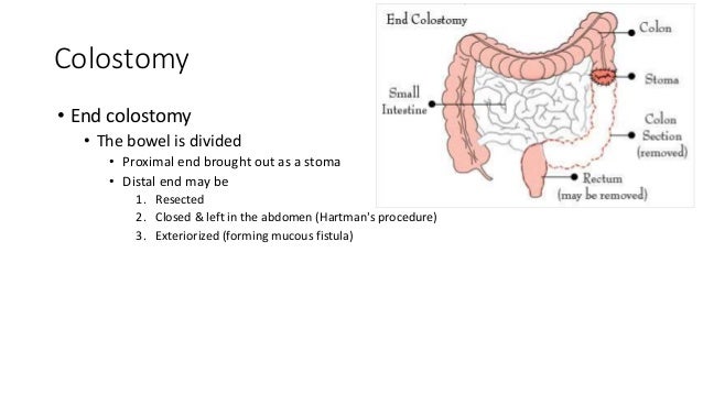 stoma