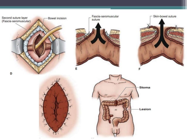 intestinal Stoma