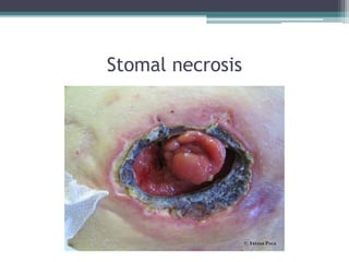 Stomal necrosis
 