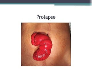 Prolapse
 