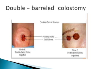 Stoma Inversion Stoma in surgery | PPT