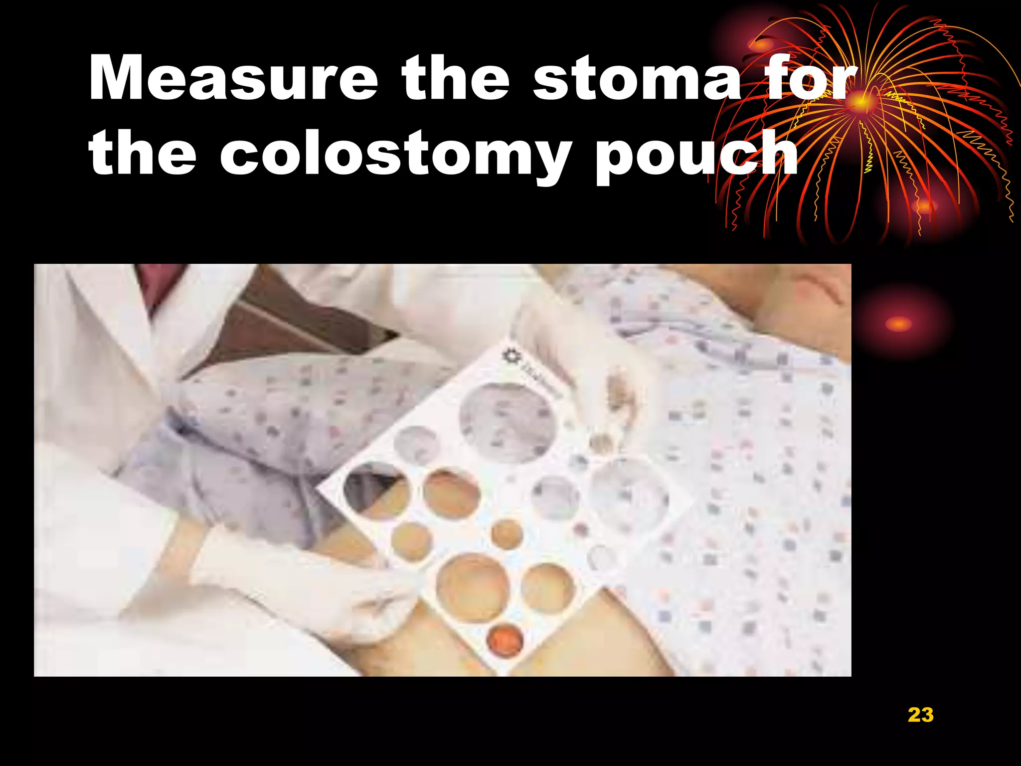 Measure the stoma for
the colostomy pouch
23
 