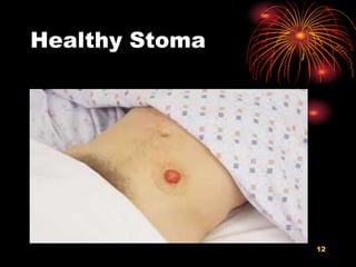 Healthy Stoma
12
 