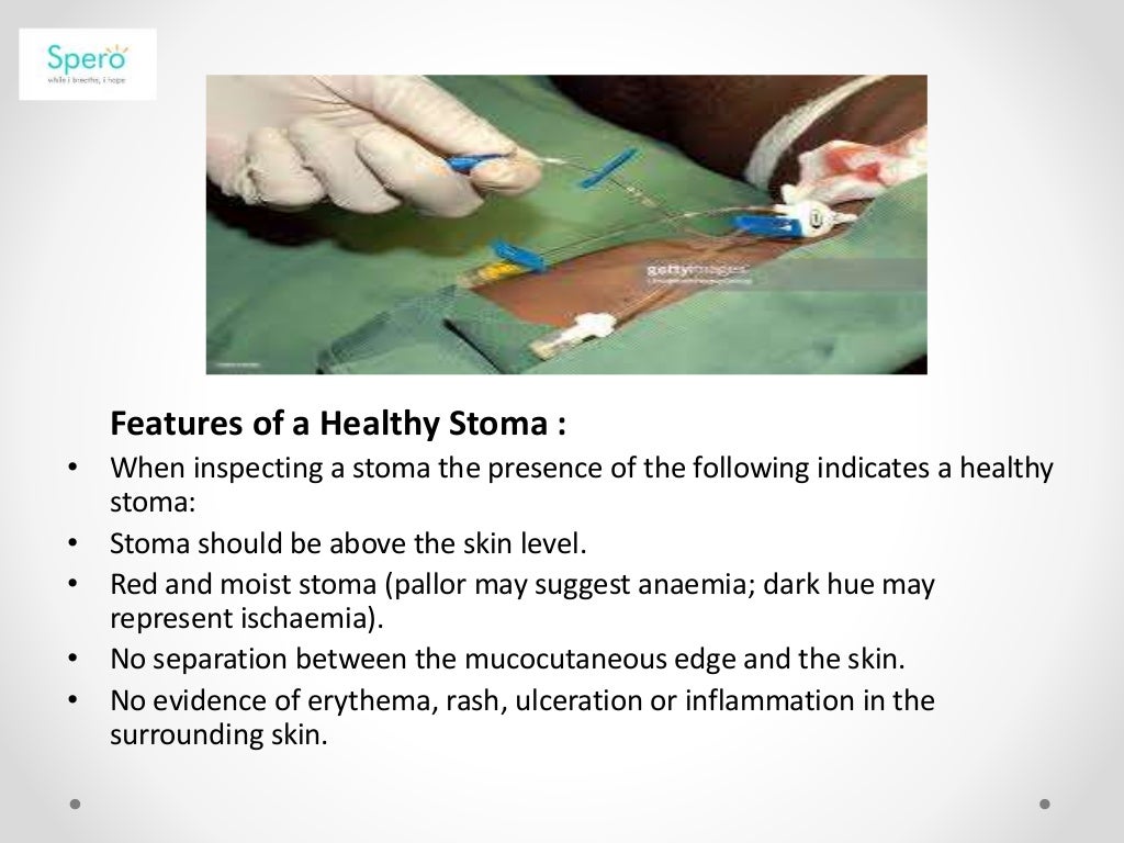 Stoma care