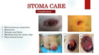 STOMA CARE
Complications
 Mucocutaneous separation
 Retraction
 Stenosis and block.
 Bleeding from the stoma edge
 Para-stomal hernia
 