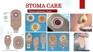 STOMA CARE
Stoma Appliances- Types
 