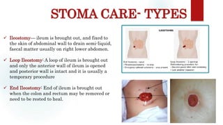 STOMA CARE- TYPES
Sites: occiput, scapula, ischium, sacrum, heel
 Ileostomy— ileum is brought out, and fixed to
the skin of abdominal wall to drain semi-liquid,
faecal matter usually on right lower abdomen.
 Loop Ileostomy: A loop of ileum is brought out
and only the anterior wall of ileum is opened
and posterior wall is intact and it is usually a
temporary procedure
 End Ileostomy: End of ileum is brought out
when the colon and rectum may be removed or
need to be rested to heal.
 