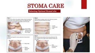 STOMA CARE
Selecting Optimal Stomal site
 