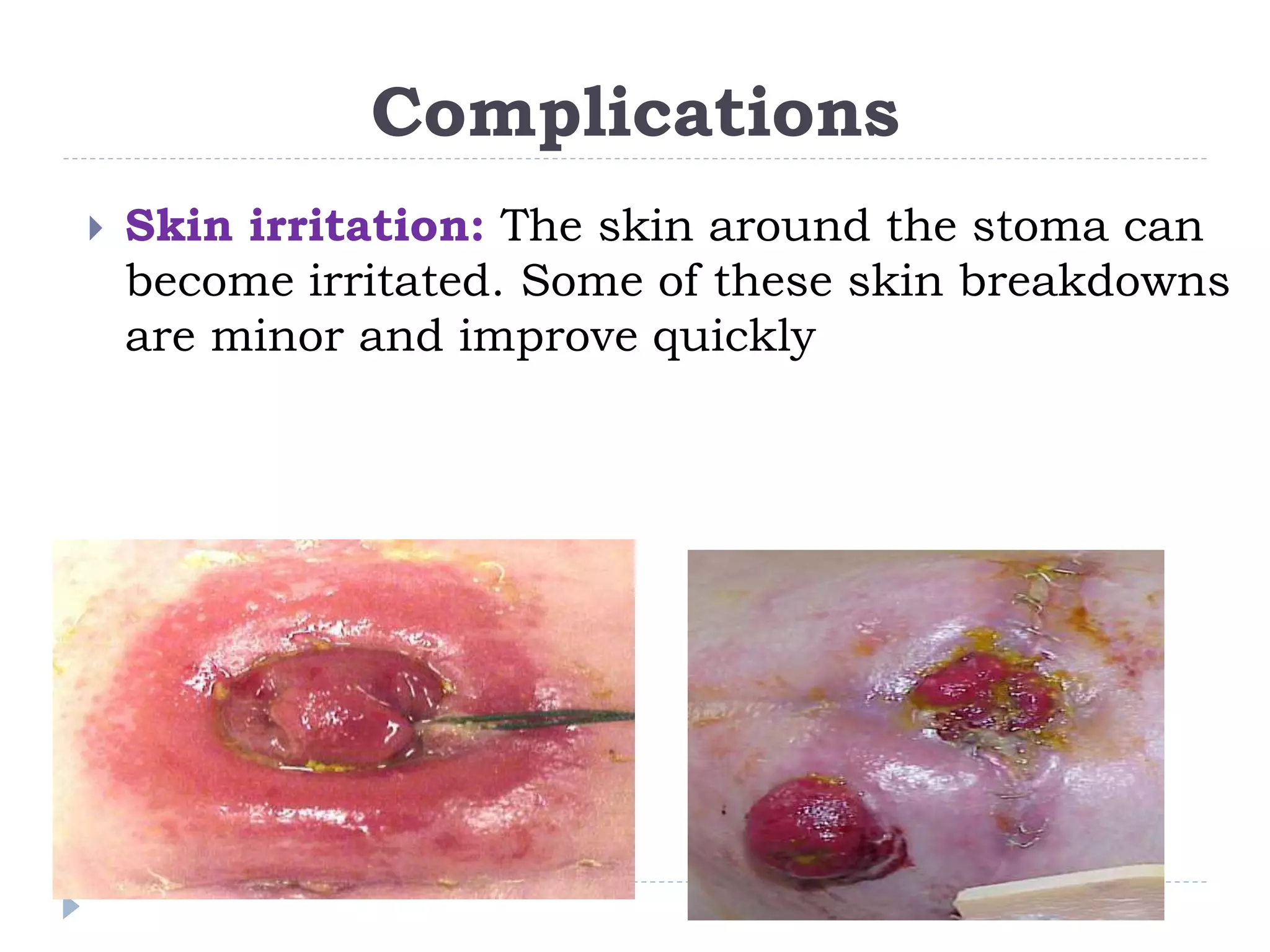 Stoma Care 1 ppt stoma-care-1-ppt