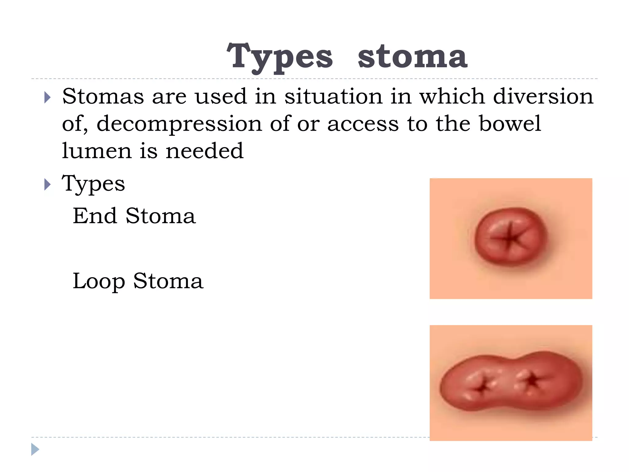 Stoma Inversion Stoma Care (1).ppt