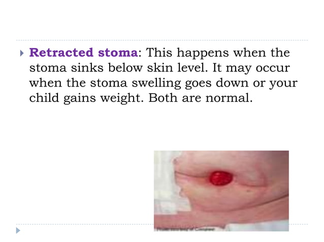 Stoma Care (1).ppt