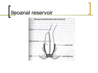 Ileoanal reservoir
 