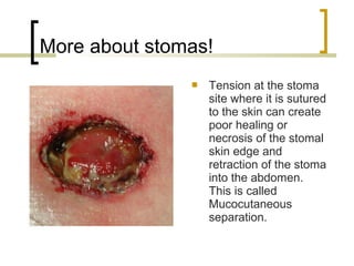 More about stomas!
 Tension at the stoma
site where it is sutured
to the skin can create
poor healing or
necrosis of the stomal
skin edge and
retraction of the stoma
into the abdomen.
This is called
Mucocutaneous
separation.
 
