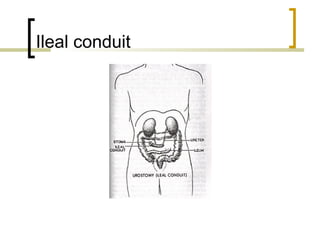 Ileal conduit
 