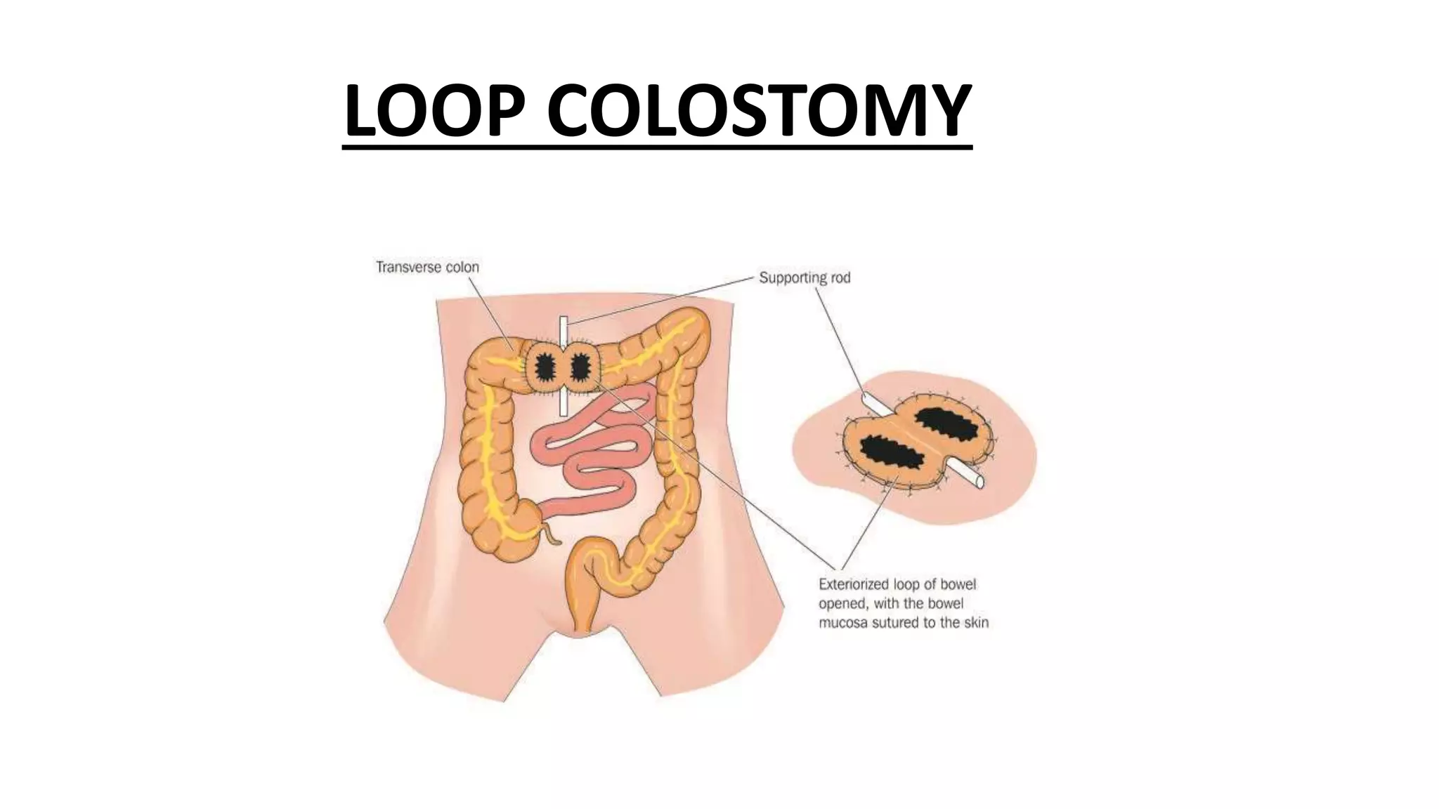 Simple Loop Colostomy STOMA CARE BY SIS. RAMA.pptx