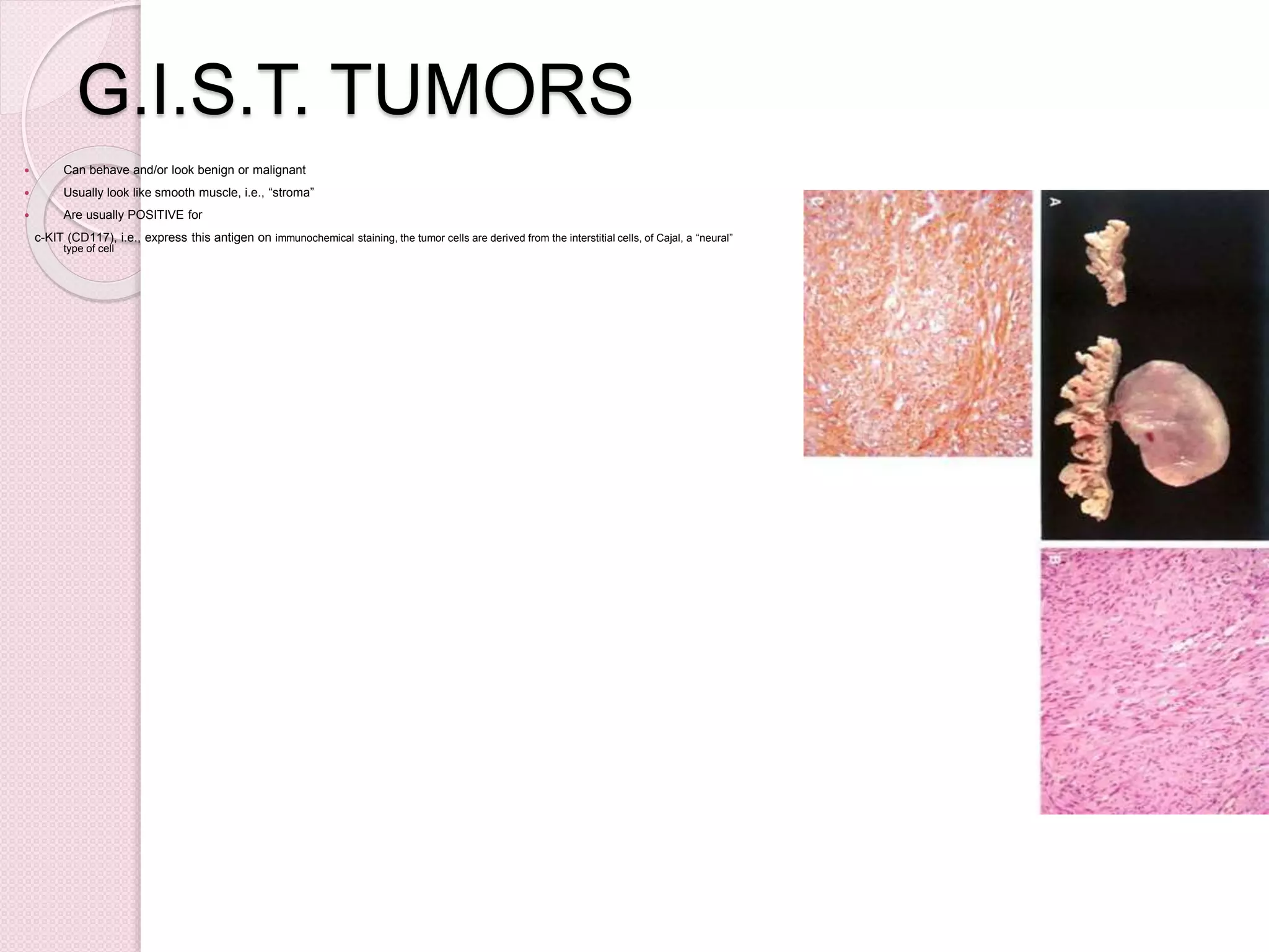 G.I.S.T. TUMORS
 Can behave and/or look benign or malignant
 Usually look like smooth muscle, i.e., “stroma”
 Are usually POSITIVE for
c-KIT (CD117), i.e., express this antigen on immunochemical staining, the tumor cells are derived from the interstitial cells, of Cajal, a “neural”
type of cell
 
