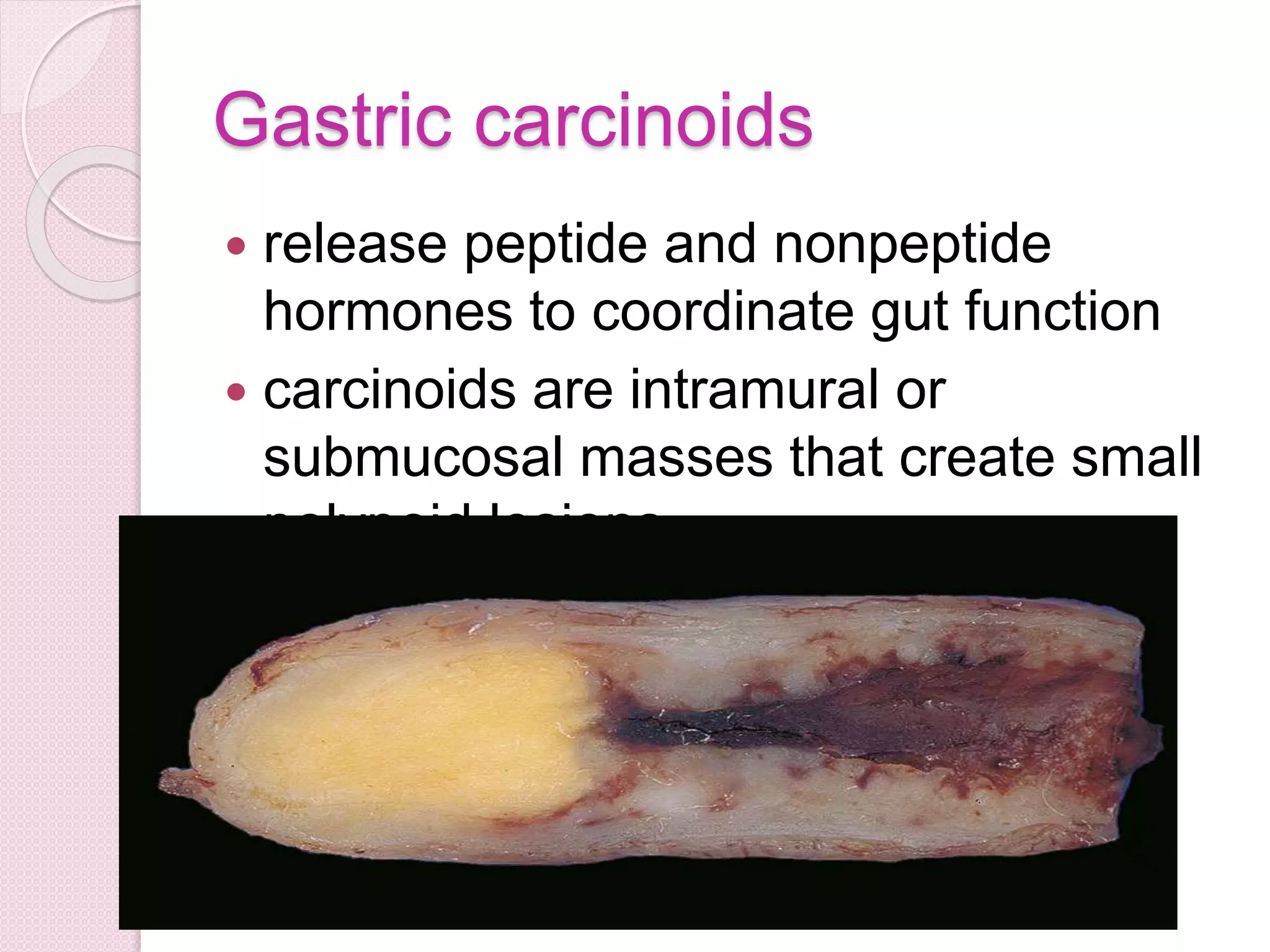 Gastric carcinoids
 release peptide and nonpeptide
hormones to coordinate gut function
 carcinoids are intramural or
submucosal masses that create small
polypoid lesions
 